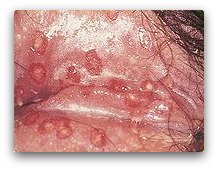 Genital Herpes Treatment